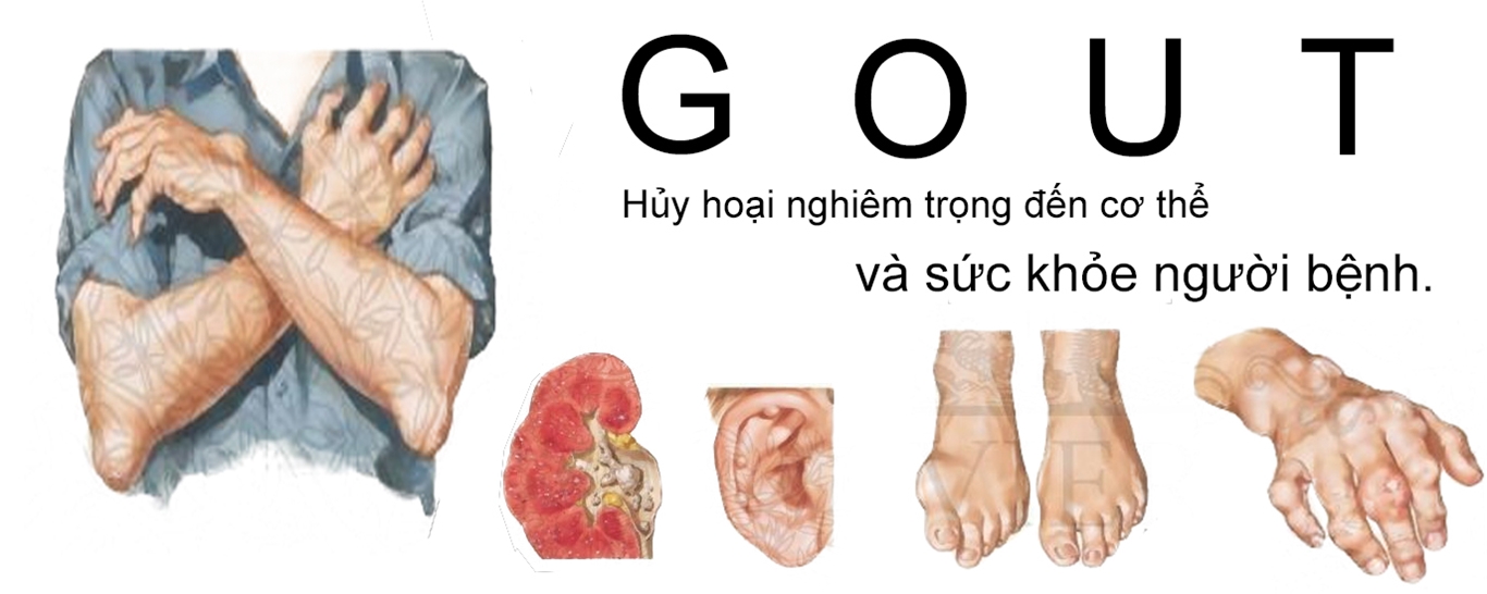 Bệnh Gout ảnh hưởng đến sức khỏe