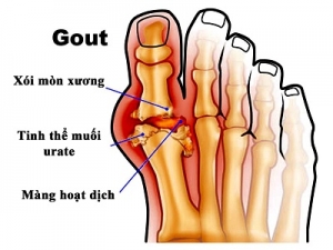 Dấu hiệu của bệnh Gout