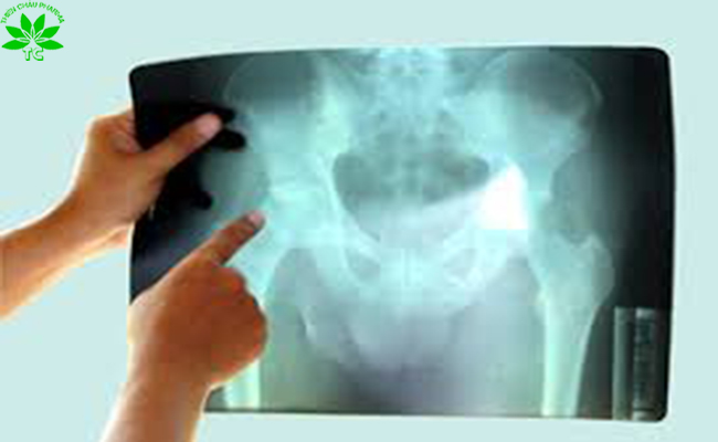 ​Hình ảnh X-quang bệnh hoại tử chỏm xương đùi